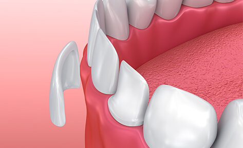 veneers diagram